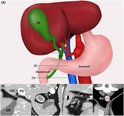 Computed tomographic quantitative evaluation of common bile duct size in normal dogs: A reference range study considering body weight